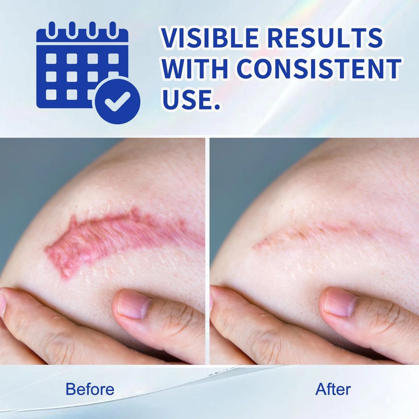 Silicone Scar Cream for Old and New Scars