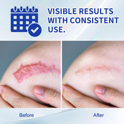 Silicone Scar Cream for Old and New Scars